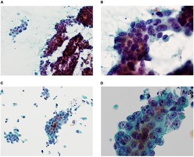 The usefulness of liquid-based cytology for endoscopic ultrasound-guided tissue acquisition of solid pancreatic masses